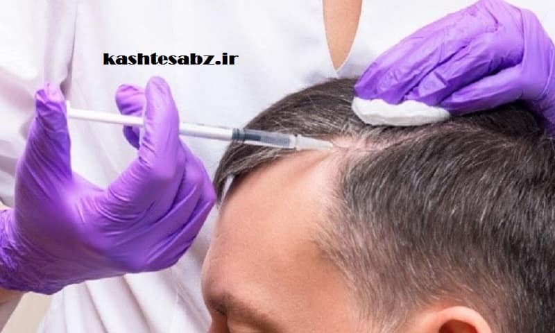 بهترین زمان مزوتراپی بعد از کاشت