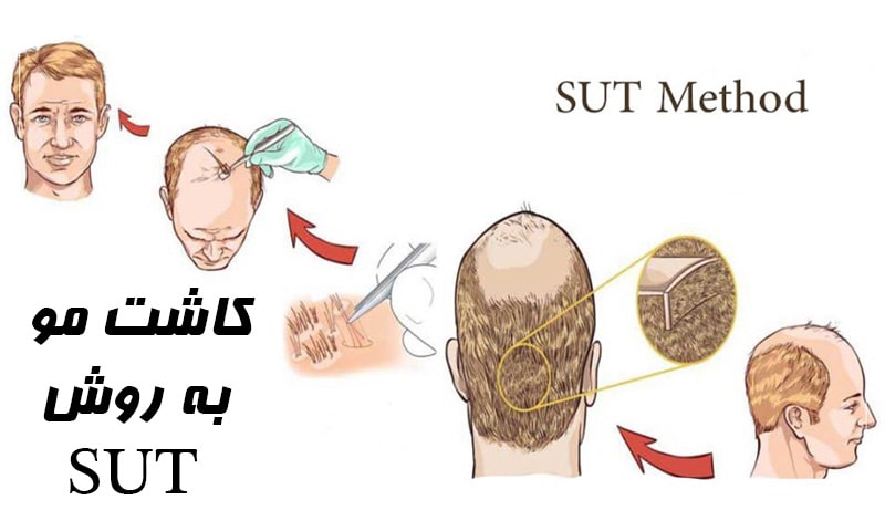 کاشت مو به روش SUT